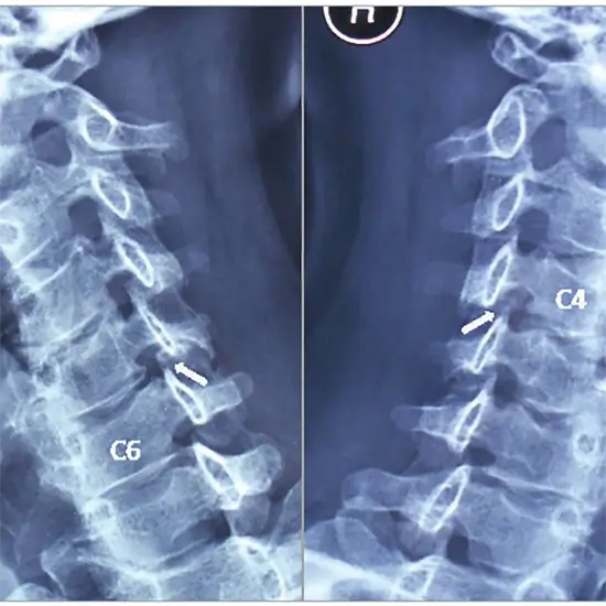 X-ray Cervical Spine Both Oblique Views
